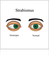 Strabismus - crossed eyes treatment in Chicago